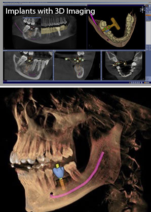 Implants with and without 3D imaging